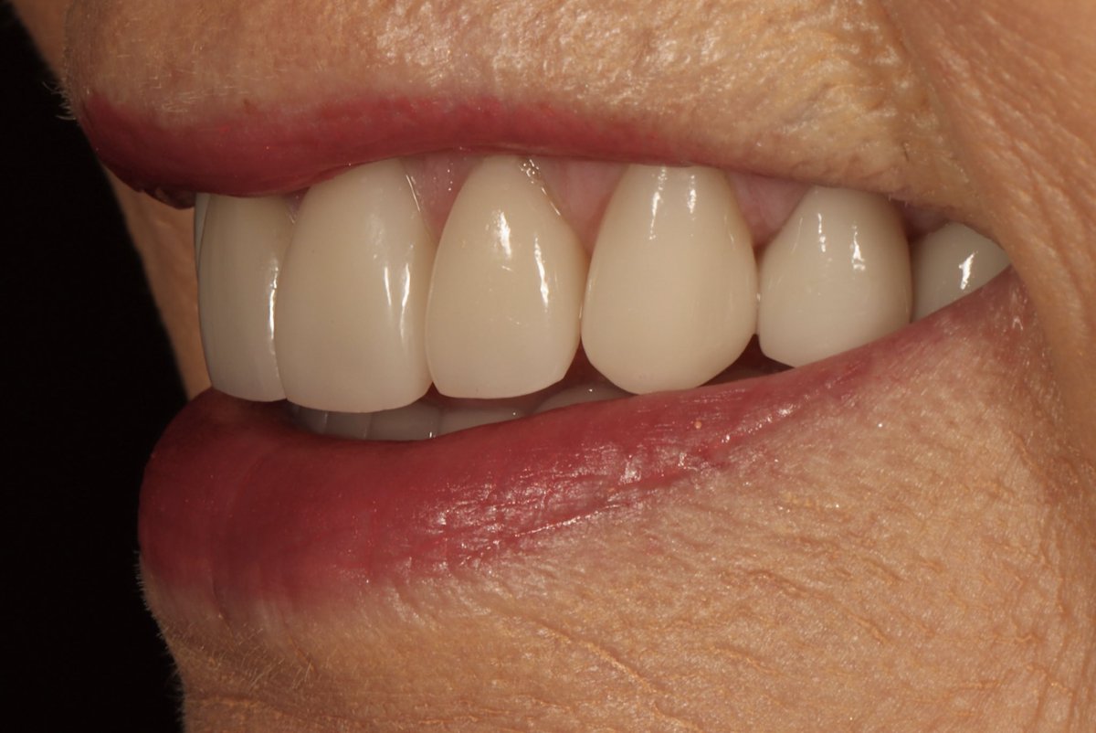 AmarilloSmiles's tweet photo. This patient is loving her total smile makeover we completed this week! Through this process, Dr. Miller and our team were able to design and construct her ideal smile and bite position, and also improve her TMJ (jaw joints) function, and her airway function at the same time! https://t.co/fLgBPDniAD