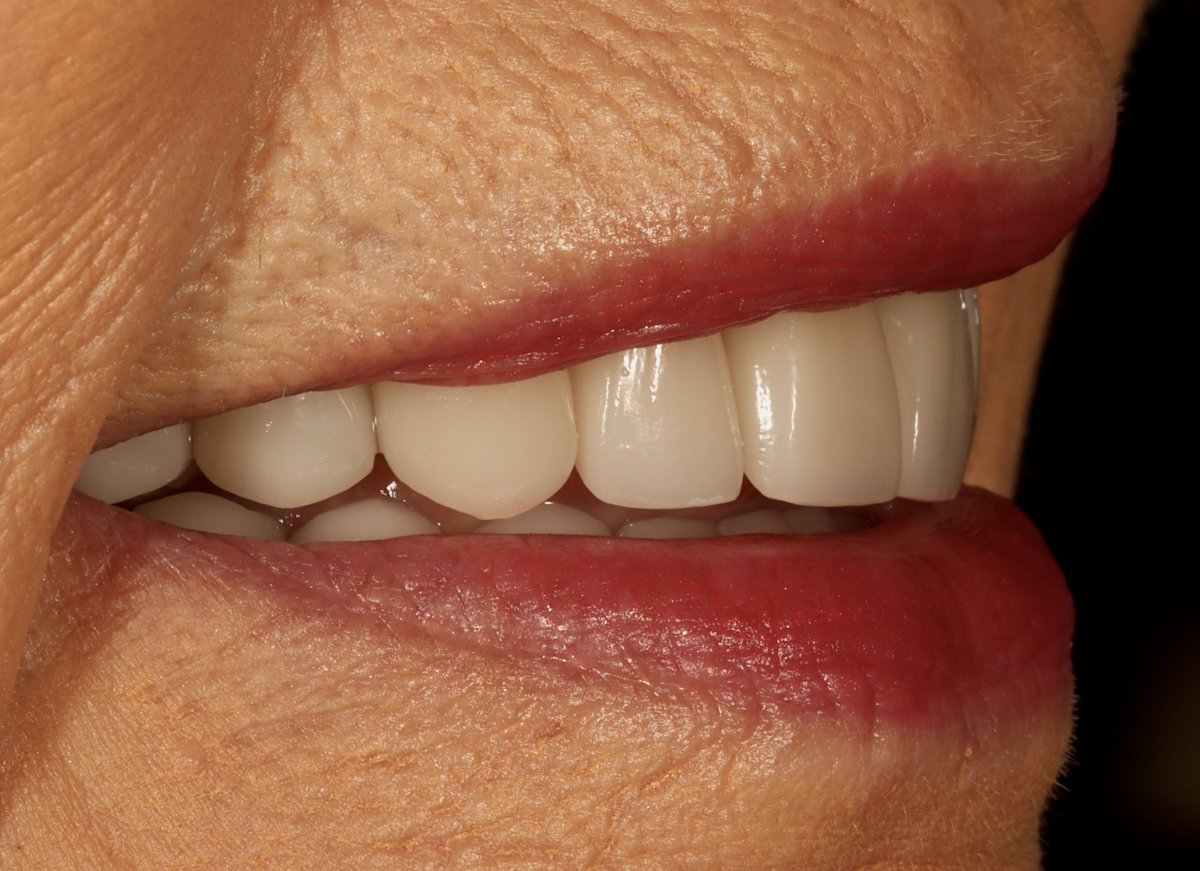AmarilloSmiles's tweet photo. This patient is loving her total smile makeover we completed this week! Through this process, Dr. Miller and our team were able to design and construct her ideal smile and bite position, and also improve her TMJ (jaw joints) function, and her airway function at the same time! https://t.co/fLgBPDniAD