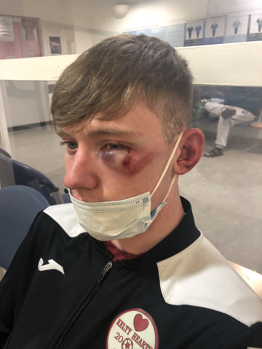 stevie_204's tweet image. The joys of football and being a goalie putting your heed where’s there’s feet!!! #daftgoalies