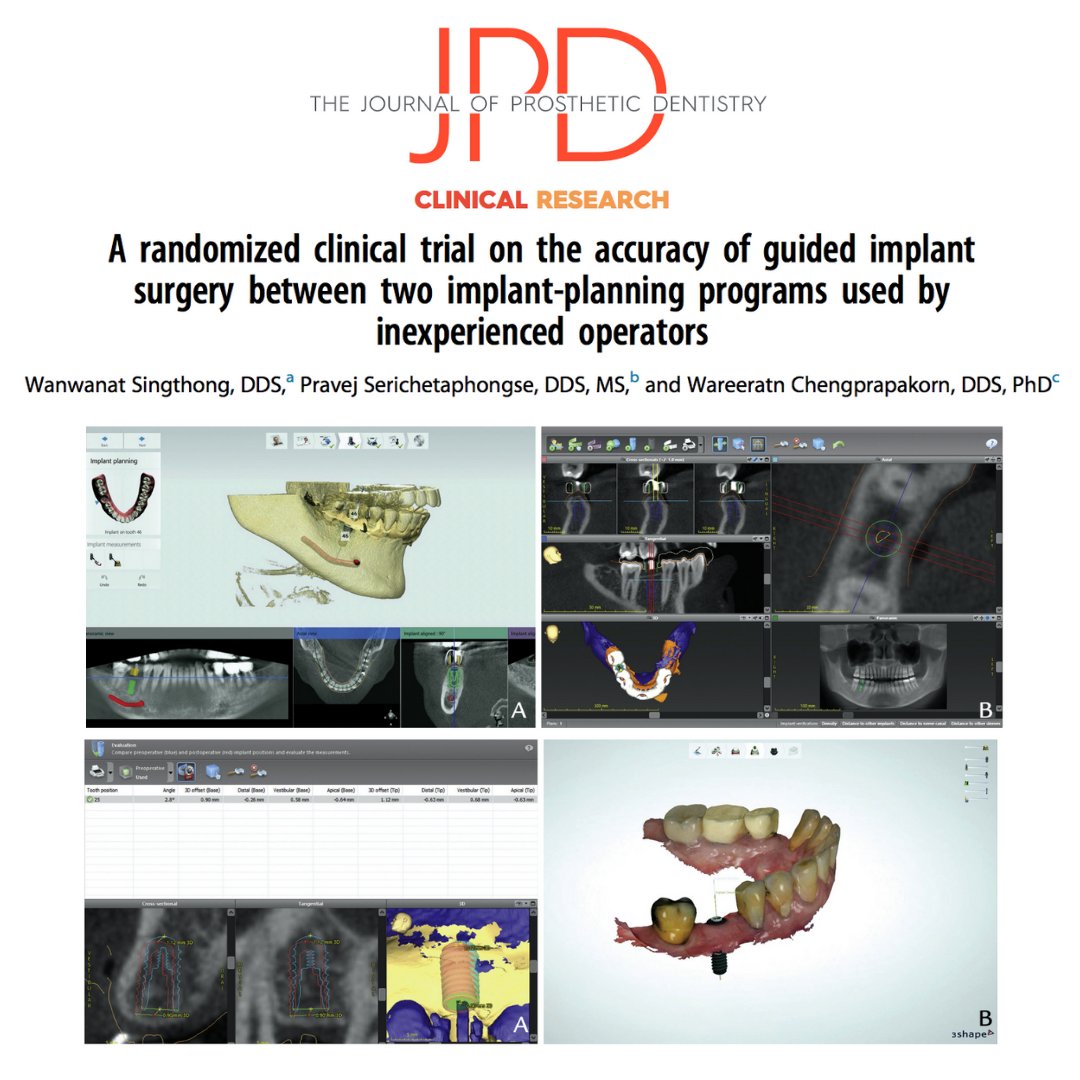 JPDentistry's tweet photo. An #implantsurgicalguide can make the accurate placement of a #dentalimplant a more straight forward process. This #randomizedclinicaltrial assesses the accuracy of these guides when used by inexperienced surgeons.
Learn more: https://t.co/meapHKyIzi https://t.co/6PssejHW39