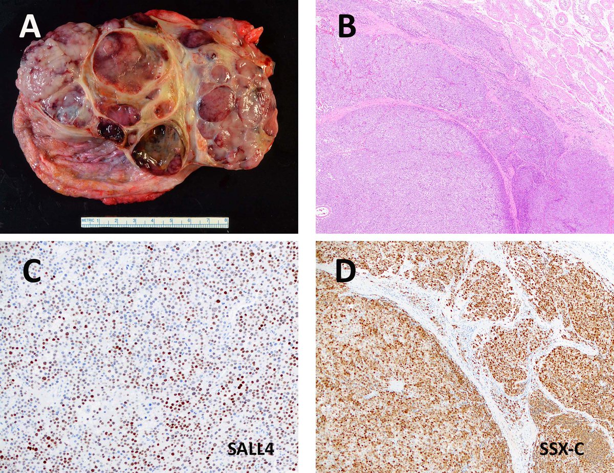 Happy to share our study on the Cytogenetics of Spermatocytic Tumors!

sciencedirect.com/science/articl…