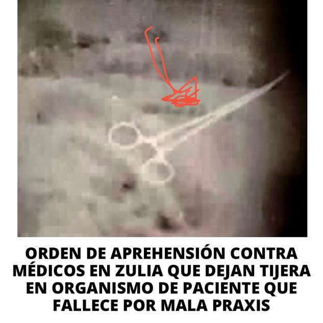 RobertLobo_'s tweet photo. #AHORA Ministerio Público de Maduro emite orden de aprehensión contra Luis Gomez, Gerardo Nuñez y Evert Colina, médicos del Hospital Universitario de Maracaibo: al causarle la muerte a un ciudadano por dejarle dentro de su cuerpo una pinza quirúrgica. https://t.co/P8qEBiKHXr
