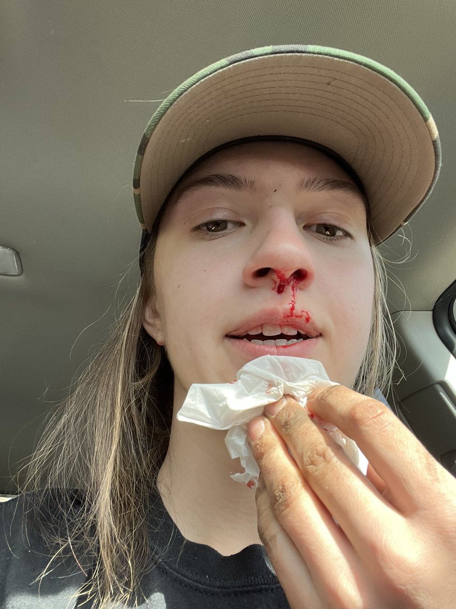 Got popped pretty good in the nose today by a mini pony.