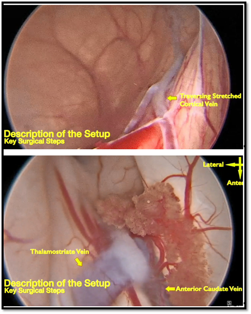 StevenBrem's tweet photo. Kudos to @Doctor_OC_, Dimentberg R, Borja AJ, Glauser G: Endoscopic fenestration of a giant frontal arachnoid cyst: Operative technique and anatomical nuances - PubMed (https://t.co/vP6PzoDJyu)  @PennNSG #arachnoidcyst #endoscope https://t.co/rqVlLvjekQ https://t.co/7XDSydkawt