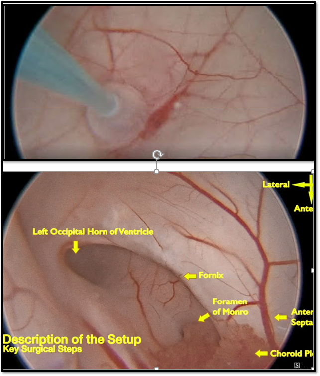 StevenBrem's tweet photo. Kudos to @Doctor_OC_, Dimentberg R, Borja AJ, Glauser G: Endoscopic fenestration of a giant frontal arachnoid cyst: Operative technique and anatomical nuances - PubMed (https://t.co/vP6PzoDJyu)  @PennNSG #arachnoidcyst #endoscope https://t.co/rqVlLvjekQ https://t.co/7XDSydkawt