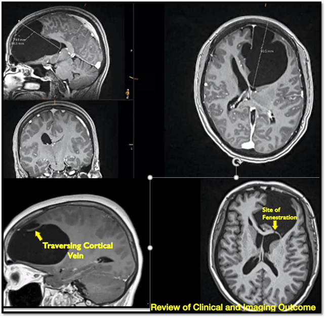 StevenBrem's tweet photo. @StevenBremMD Kudos to @Doctor_OC_ , R Dimentberg, AJ Borja, G Glauser, et al. for publication of video showing endoscopic fenestration of a giant arachnoid cyst. @PennNSG #arachnoidcyst https://t.co/rqVlLvjekQ https://t.co/izzKJjN46G