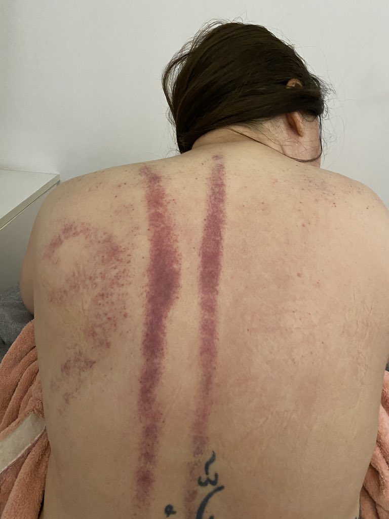 TravelTechTeach's tweet photo. Results of a Chinese massage with cupping. Hoping all the tension is gone for the start of spring break! https://t.co/5H0s6O1njR