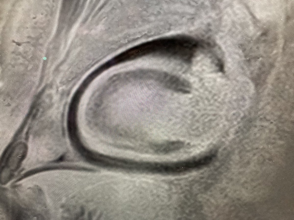 Hoffm_MD's tweet photo. „Pregnant heart“ in 2 chamber-view 💕 #cmrfirst https://t.co/qeu1o78KAz