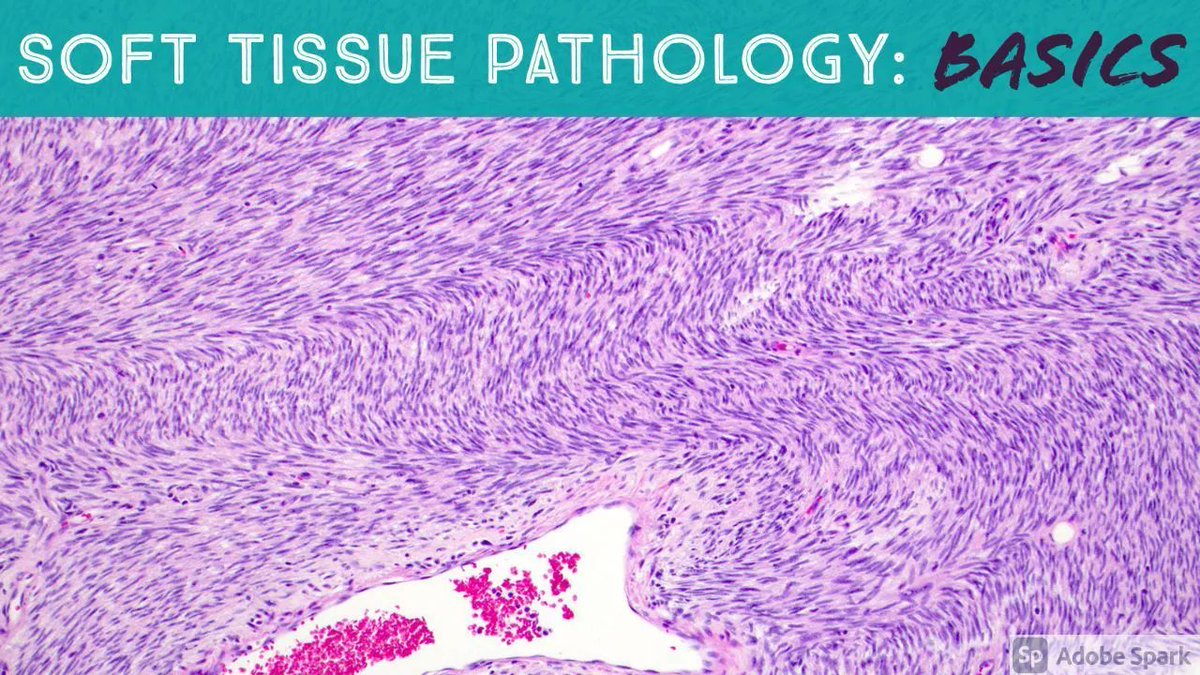 10 basic soft tissue pathology cases with discussion. Video: kikoxp.com/posts/3784. WSI digital slides coming soon. Thx to my resident, Dr. Terrance Lynn, for helping me make this video!  #pathology #pathologists #PathTwitter #BSTpath #dermpath
