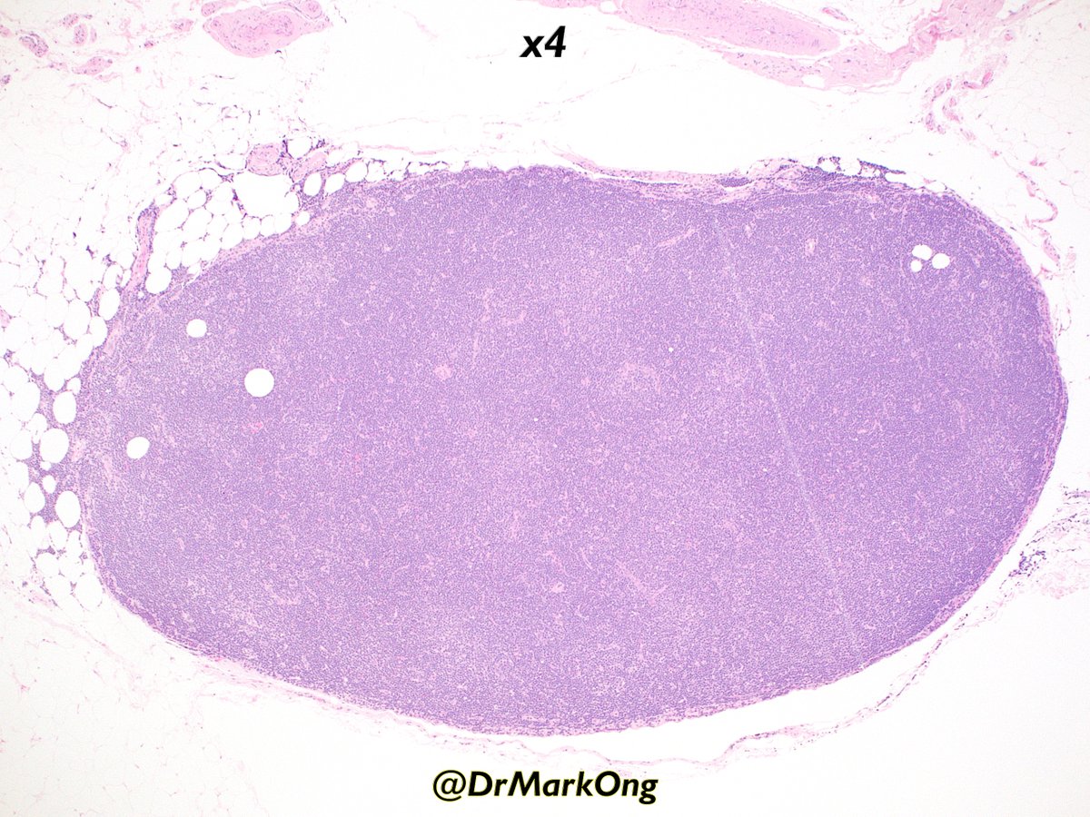 Neck lymph node excision biopsy.

What's your diagnosis on low power?

#LPpath #hemepath