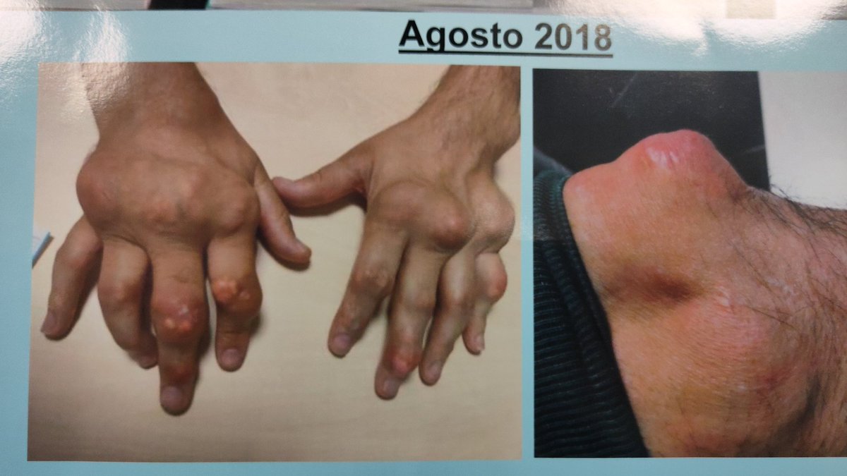 cesardiaztorne's tweet photo. II concurso de casos clínicos #GEACSER 
El tamaño sí que importa. 
Gran competencia de los 6 casos que llegaron a la final @david_lobo2 @enriquecalvoA @alexprada81 #tofo #gota @basiliu #cppd https://t.co/QYel9bilno