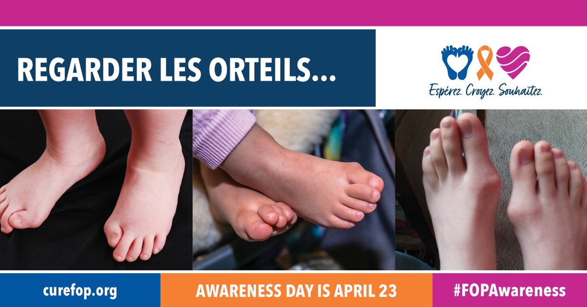 fopfrance's tweet photo. Saviez-vous que ces orteils etaient l' indicateur clé de la FOP?
#fopfrance#curefop#fopawareness https://t.co/HuZCC2C1VR
