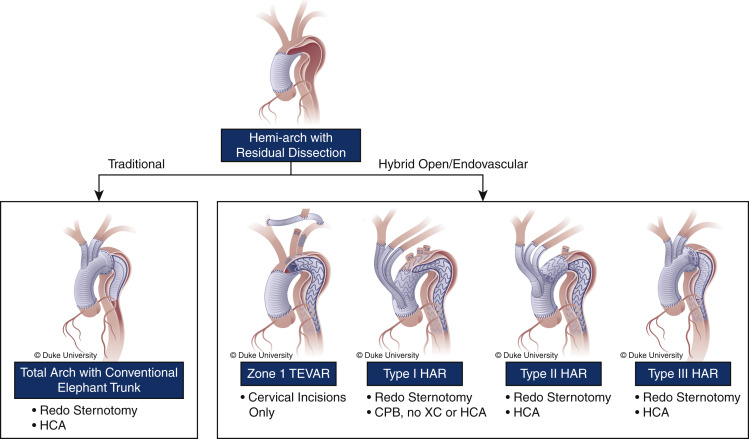 DukeAortic's tweet photo. Residual arch+/-descending dissection w/aneurysmal degeneration common late problem after ATAAD repair.  We present our institutional algorithm for approach

Tailored approach and outcomes of aortic arch reconstruction after acute type A dissection repair https://t.co/bZySPynX9G https://t.co/tAAyqPbhPQ