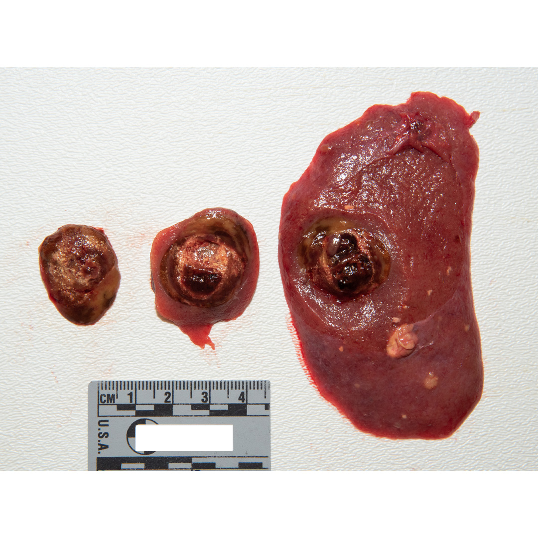 detroitsdocket's tweet photo. PRCC is usually found incidentally on imaging work up for other medical conditions. These tumors tend to be more multi-focal and bilateral (arising in many areas in both kidneys). https://t.co/7kedeAHyq6