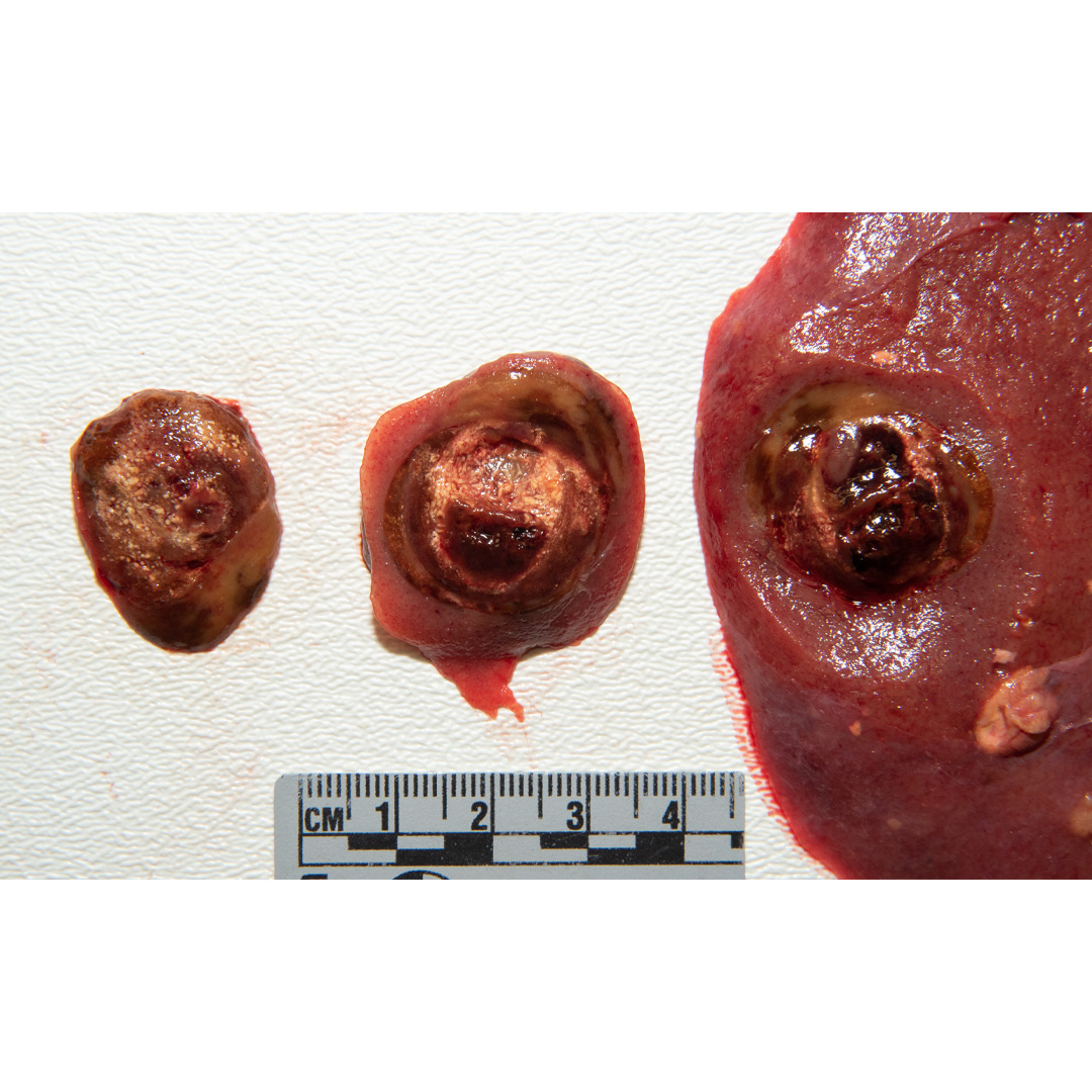 detroitsdocket's tweet photo. PRCC is usually found incidentally on imaging work up for other medical conditions. These tumors tend to be more multi-focal and bilateral (arising in many areas in both kidneys). https://t.co/7kedeAHyq6