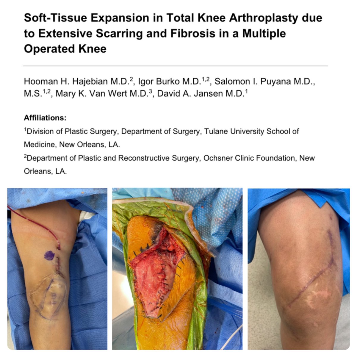 HHajebian's tweet photo. ANOTHER ACCEPTED!!💥 Despite 1st described by @normanweinzweig back in 1987, then mastered by the Insall Scott Kelly Inst. in the early 2000’s, there’s still hardly any data on #SoftTissueExpansion in #TKA! Keep an 👀 out via @ePlasty1 @SalomonPuyana DavidAJansen @Tulane_Plastics https://t.co/nE8WBctdE8