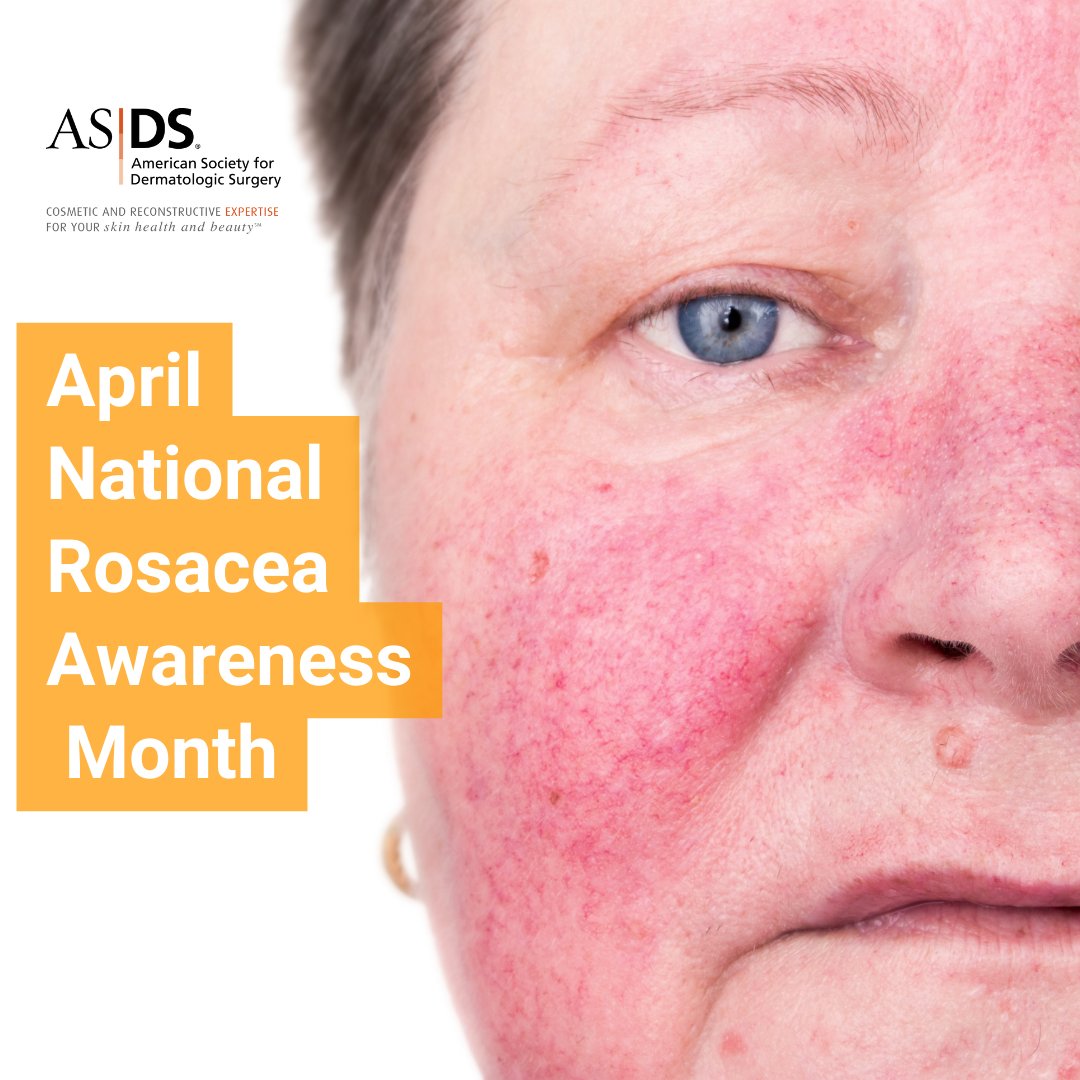 April is #RosaceaAwarenessMonth. Rosacea affects 16 million Americans. Consult your board certified dermatologist to discuss which treatment options may be best for you.