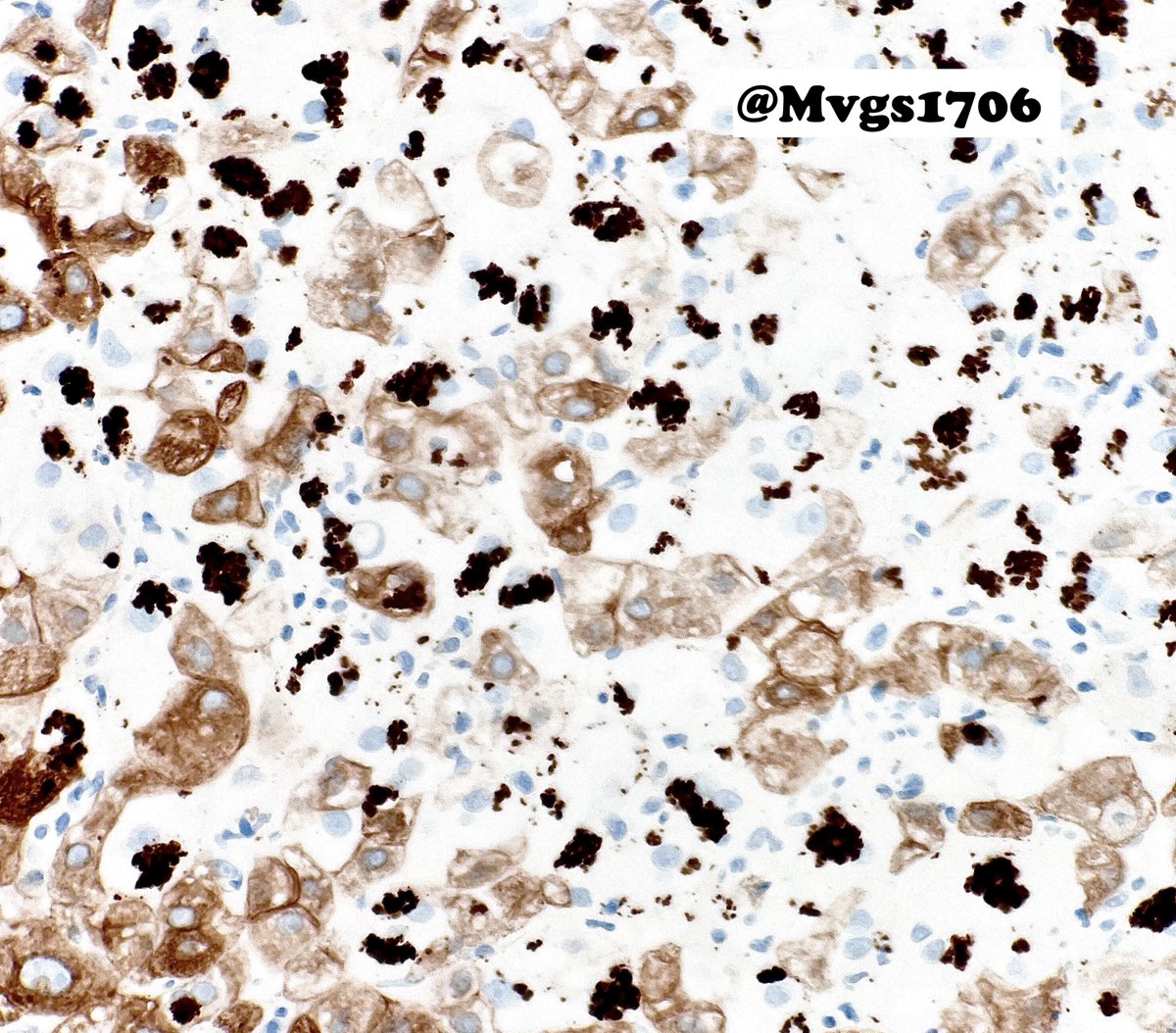 Hi #pathology residents &amp; fellows..can you guess the immunohistochemical stain and the process?

#PathTwitter #GIpath #liverpath (clue ??😉)