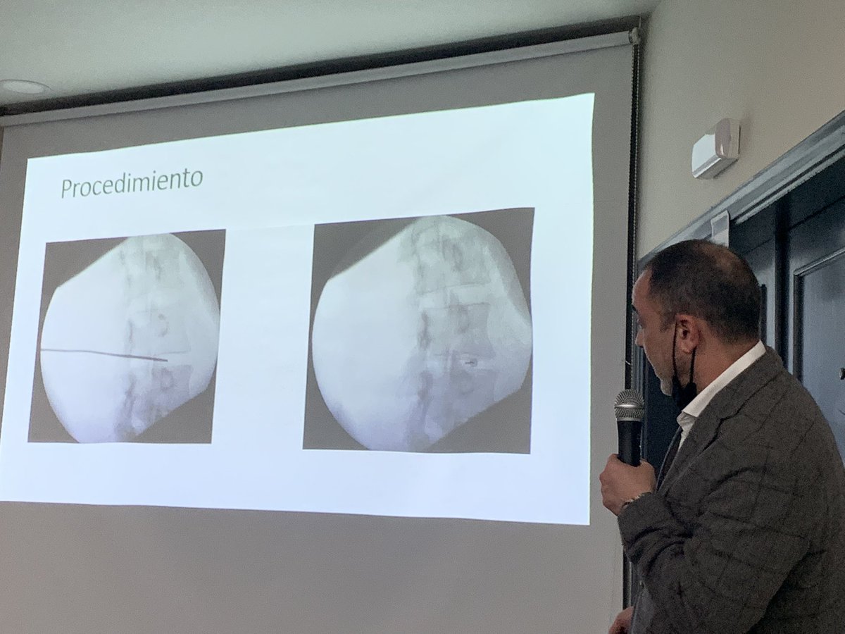 Seguimos en <a href="/socadolor/">Socadolor</a> con tratamiento del #dolor lumbar discogénico por <a href="/mardominguezgar/">mar dominguez garcia</a> <a href="/DrAbejon/">Dr. David Abejón</a> y Dra Silvia Santiago

🥏Ablación RFC de N Sinuvertebral 👉🏿 #dolor vertebrogénico 
🥏Discolisis percutanea con etanol gelificado y tungsteno👉🏿dolor radicular en hernia contenida