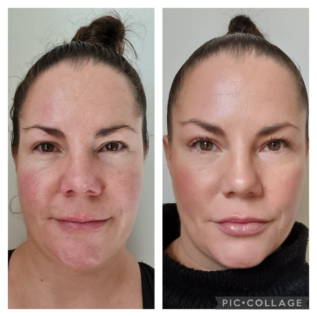 CatLovesBeauty's tweet image. Before and after #RevolutionBeauty #rosacea #perfectshade #daytimemakeup