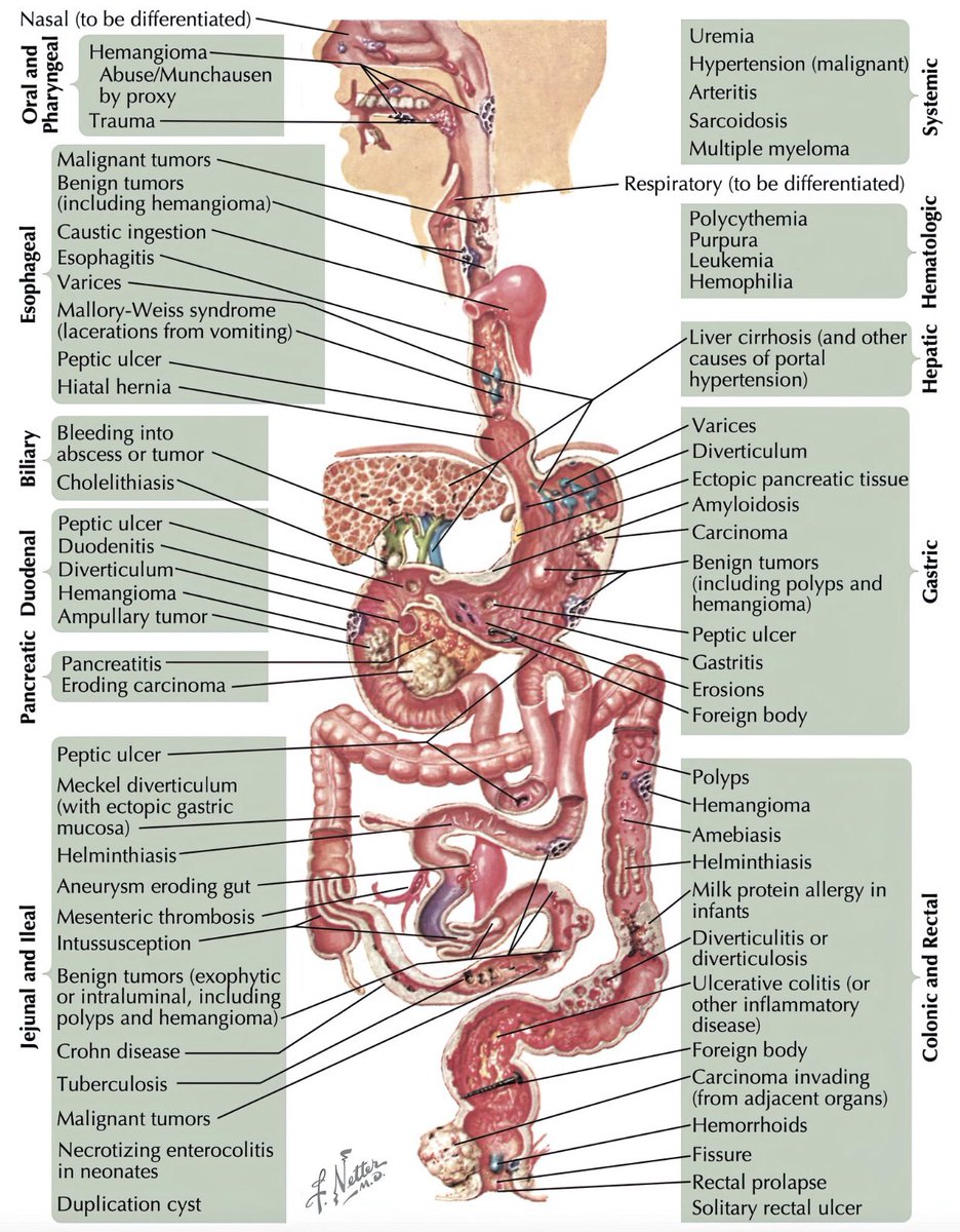 Medical_MD1's tweet photo. Differential Diagnosis of GI bleeding 🩸😣

. https://t.co/mYQADzW85Q