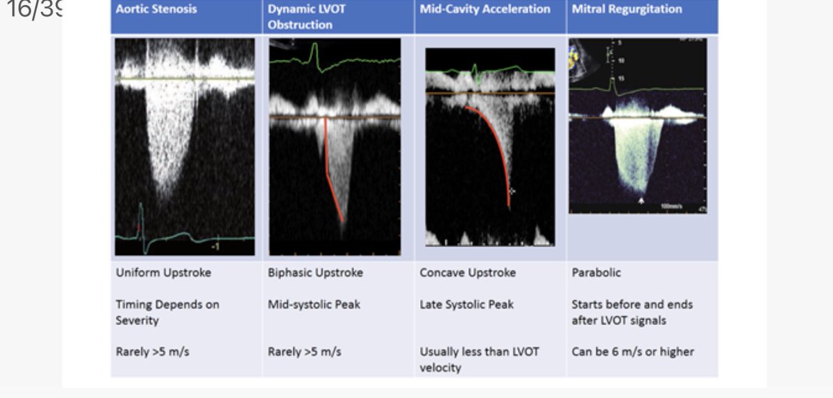 Renu (@renujain19) on Twitter photo Spectral Doppler shape so helpful in differentiating left-sided lesions. MR vs AS vs LVOT vs Mid-ventricular obstruction. Lots of learning at JOINT <a href="/ASE360/">American Society of Echocardiography</a> <a href="/ACCinTouch/">American College of Cardiology</a> 💥”Thick Hearts” 💥 Session #ACC22 Spectral Doppler shape so helpful in differentiating left-sided lesions. MR vs AS vs LVOT vs Mid-ventricular obstruction. Lots of learning at JOINT <a href="/ASE360/">American Society of Echocardiography</a> <a href="/ACCinTouch/">American College of Cardiology</a> 💥”Thick Hearts” 💥 Session #ACC22