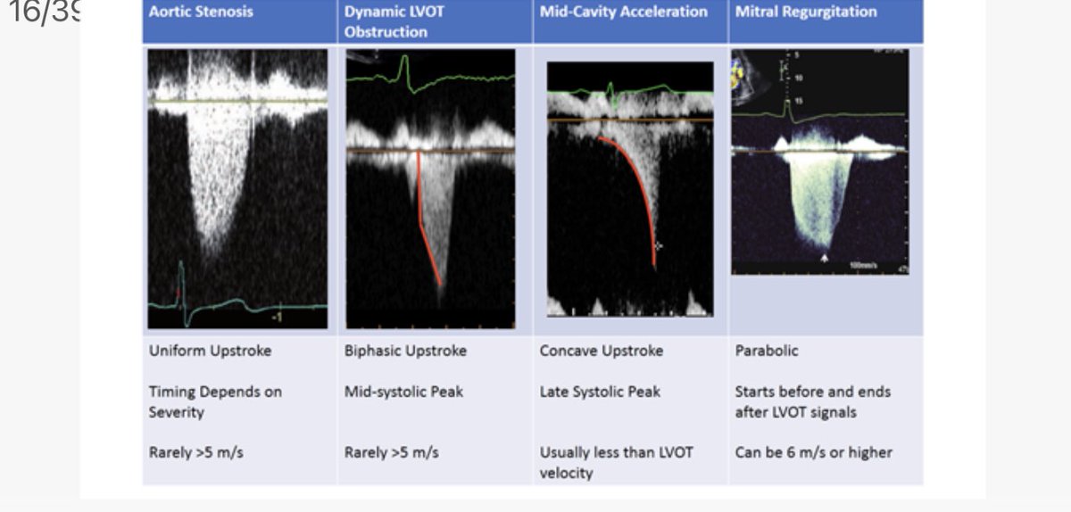 Spectral Doppler shape so helpful in differentiating left-sided lesions. MR vs AS vs LVOT vs Mid-ventricular obstruction. Lots of learning at JOINT @ASE360 @ACCinTouch 💥”Thick Hearts” 💥 Session #ACC22