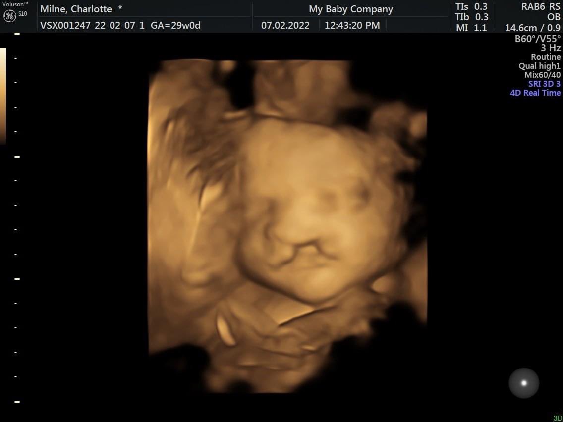 Charlotte170205's tweet photo. she will not be able to breastfeed but I’m determined to give her what she needs 💜 #Cleft #CleftBaby #CLAPPA @CLAPACOMMUNITY https://t.co/r5f1PuydWz