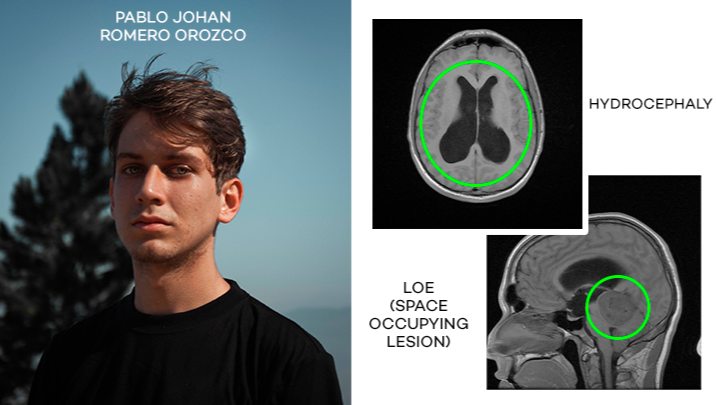 romeroo_ph's tweet photo. Hola me llamo Pablo Romero, ayúdame a cumplir mi meta para realizarme esta primera operación en mi cerebro, tengo hidrocefalia y se necesita con urgencia drenar el liquido retenido en mi cabeza con una válvula.

GoFundMe:
https://t.co/3CT0qDS3gi

❤️ABRIR HILO⏬ https://t.co/hTXv7RzYQB