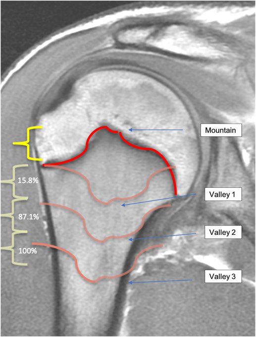 DrJustinAlbert1's tweet photo. The Axillary Nerve Danger Zone in Percutaneous Fixation in the Pediatric Shoulder - The “1-Mountain-3-Valleys” Principle

@Stanford_Ortho
 
@UCSDHealth
 
@UF

https://t.co/qK8EcAs1kV https://t.co/P1OYG72ynt