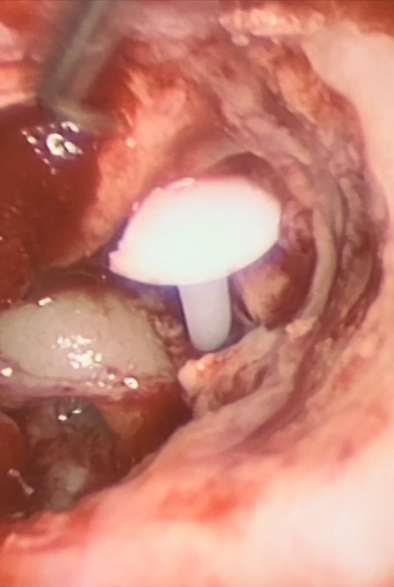 Two young patients with conductive hearing loss using hearing aids operated in January. Endoscopic ossicular reconstruction done hearing aids removed for good. #endoear #hearingrestoration #endoscopicearsurgery