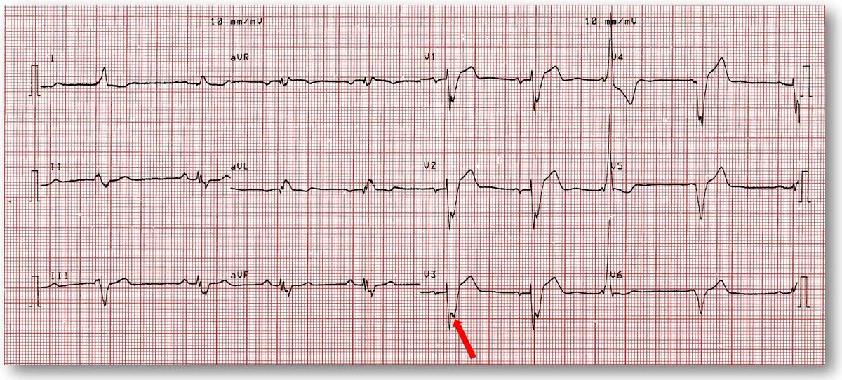 Caberera sign is A shelf like notch on ascending limb of the S wave in leads V2 to V5 often indicates an old anterior MI #ECG #MI