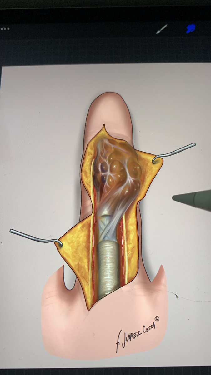 ferjuarezcesca's tweet photo. Tumor de células gigantes. #digitalart #medicalillustration #handsurgery #procreateart https://t.co/IhSdf2pM8k