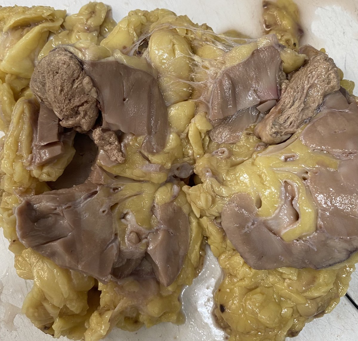 68 yr old male, Left nephrectomy. Any DDs on gross ? 
<a href="/IntSocUropath/">International Society of Urological Pathology</a> <a href="/krithik27724048/">krithika elangovan</a> @Jazzopath1 <a href="/LibinBabu15/">libin babu</a> <a href="/GU_Path_Society/">GU Pathology Society (GUPS)</a> @Ranju35760436 <a href="/kciapm/">Karnataka Chapter-IAPM (KCIAPM)</a>