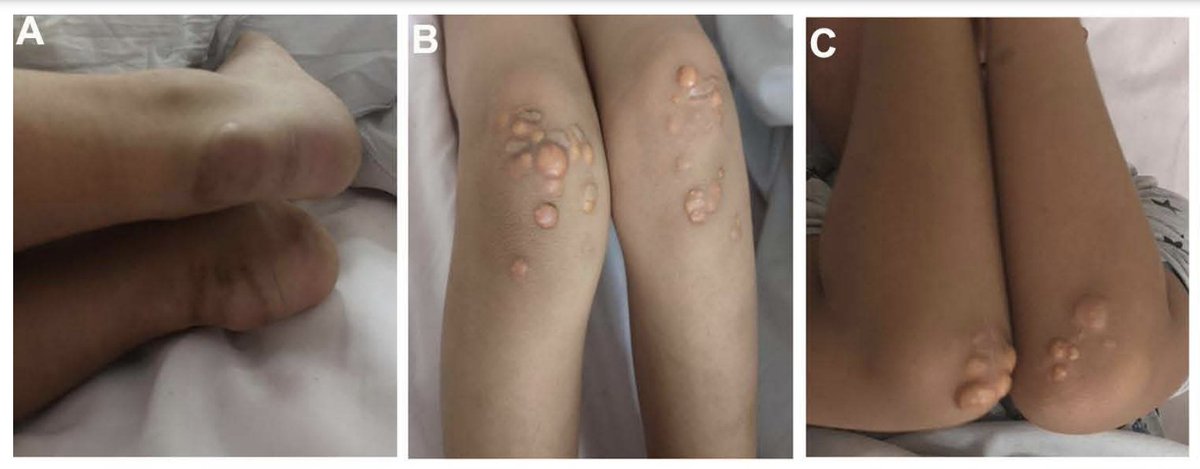 MeralKayikcoglu's tweet photo. In a 9 y/o boy, #Xanthomas were laser ablated 3 times by dermatology without measuring lipids Read article by Xu MJ 👉🏽 https://t.co/AGKMJ7cELz Seeking medical attention in HoFH @DovePress @TKDsosyal @LaleTokgozoglu @rauldsf_santos @fhpatienteurope @fhscglobal @magdadaccord https://t.co/JVV3Fz8Hok
