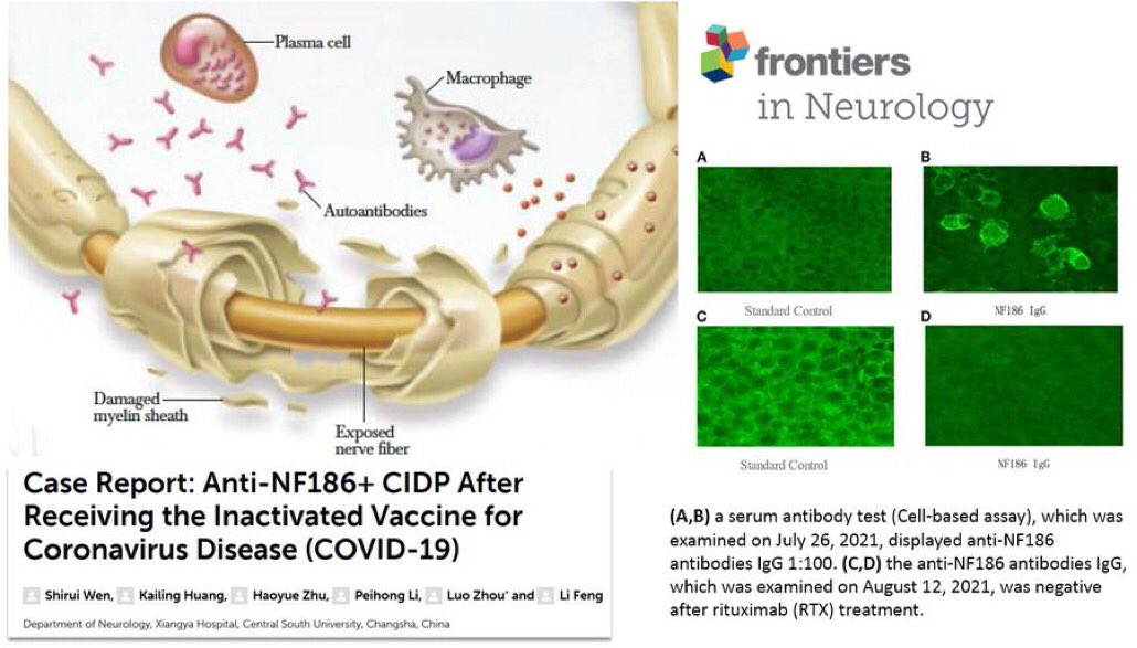 Anti-NF186+ polyneuropathie démyélinisante inflammatoire chronique (PDIC) après  injection anti-Covid : 
 Ici le cas d’un homme de 23 ans 😩
 "Les prestataires de soins de santé doivent être conscients de la possibilité de PDIC post-vaccination."

frontiersin.org/articles/10.33…