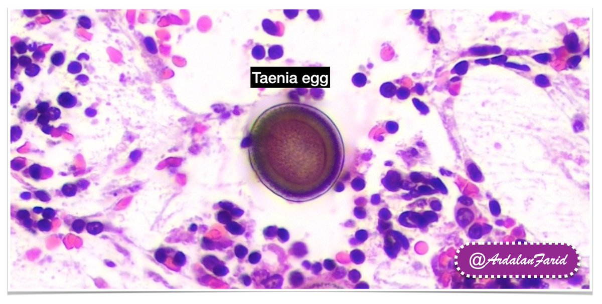 Farid Azmoudeh-Ardalan (@ardalanfarid) on Twitter photo A #Taenia #proglottid residing in the #appendix_vermiformis.
#PathTwitter
#TUMSPath
#Pathology
#TUMS A #Taenia #proglottid residing in the #appendix_vermiformis.
#PathTwitter
#TUMSPath
#Pathology
#TUMS