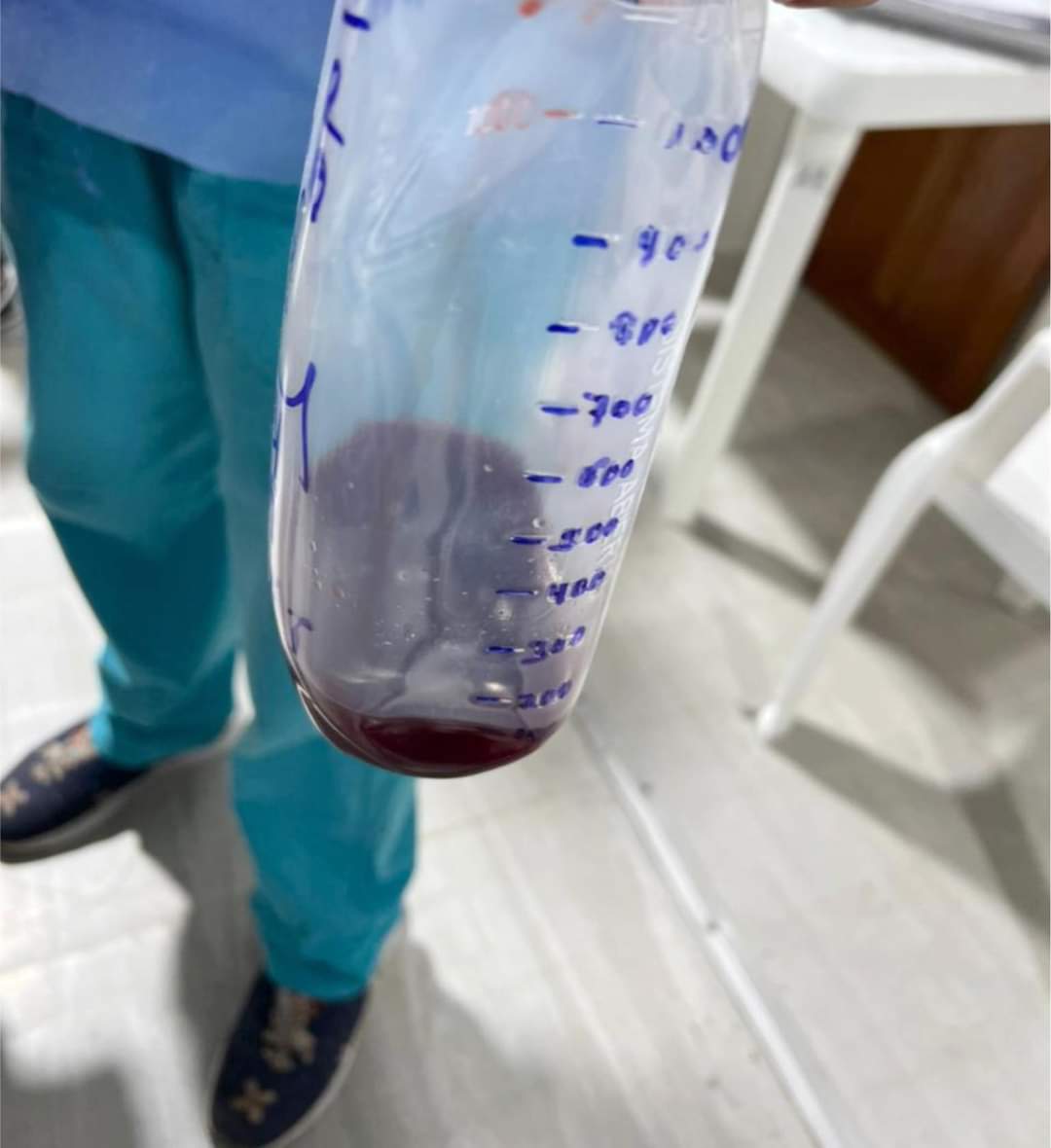 Signos de alarma en pacientes con Síndrome Febril en los trópicos (Malaria).
Uno de ellos es la orina oscura (Hemoglobinuria malarica), que nos podría alertar sobre la aparición de malaria grave.