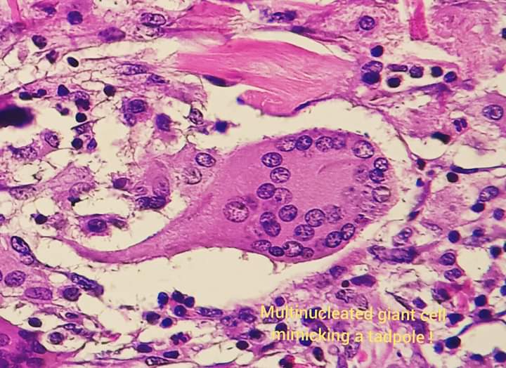 #histopath
#giantcell
Multinucleated giant cell looking like a tadpole.