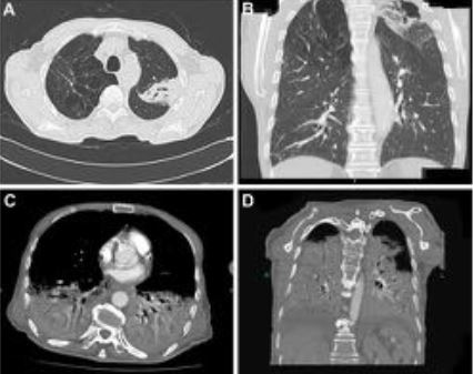 SERAM_RX's tweet photo. 📄Simuladores de #Tromboembolismo #Pulmonar 

🔎El #PiperSERAM de la semana analiza mediante #AngioTC negativos para #TEP las patologías más frecuentes que cursas con clínica simuladora y sus hallazgos #Radiológicos 

¡No te lo pierdas!▶️https://t.co/7QpCvricqI https://t.co/sWQmjjl5ca
