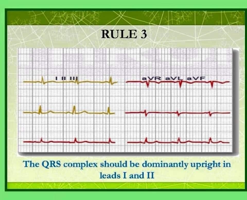 Las 🔟 Reglas del Profesor Chamberlain para la Interpretación del #ECG Normal!!!
Aquí las 3⃣ primeras!!!
Sigue el Hilo para ver las otras 7⃣!!!
👇👇👇👇👇👇👇👇👇👇