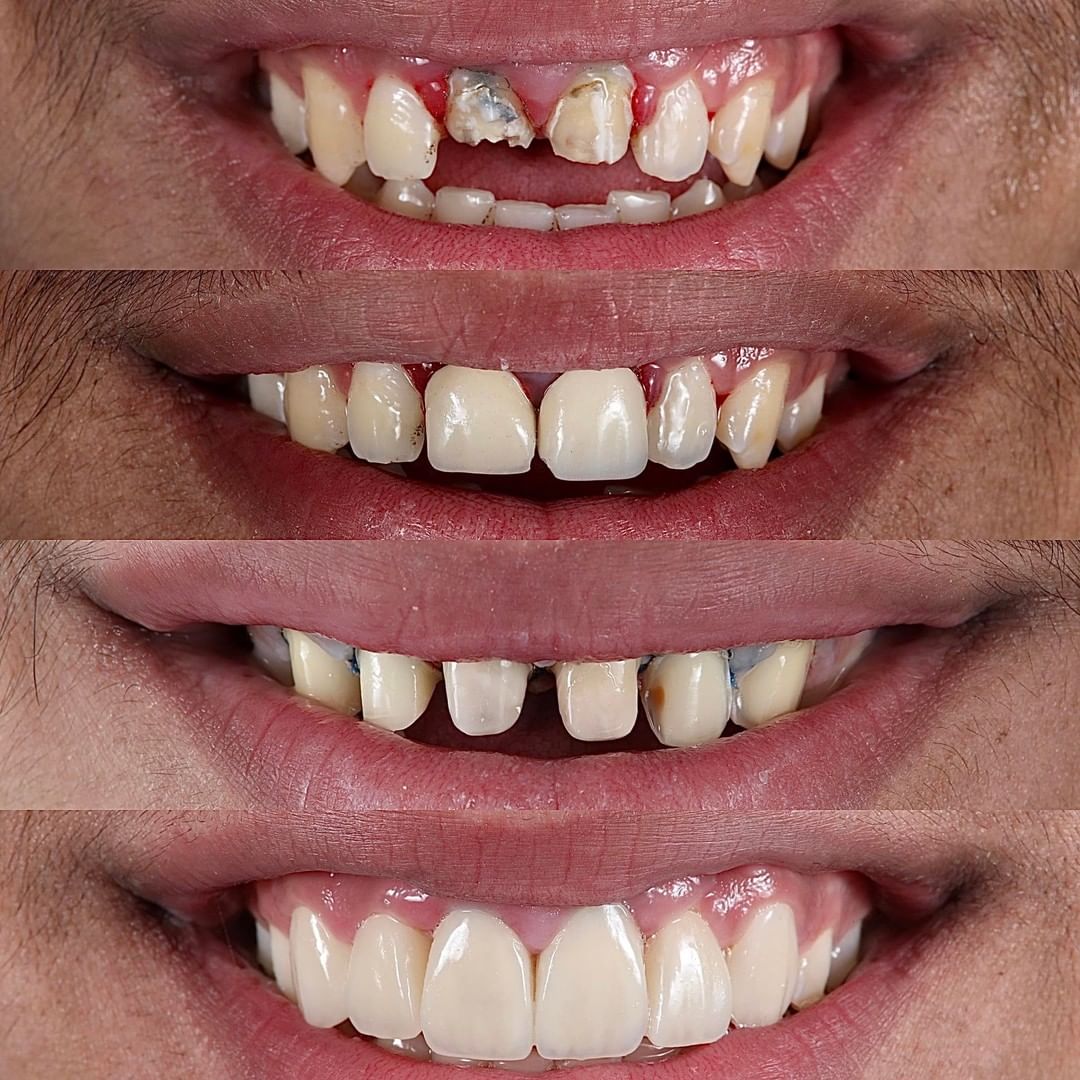 Indirect…. Healthy gum