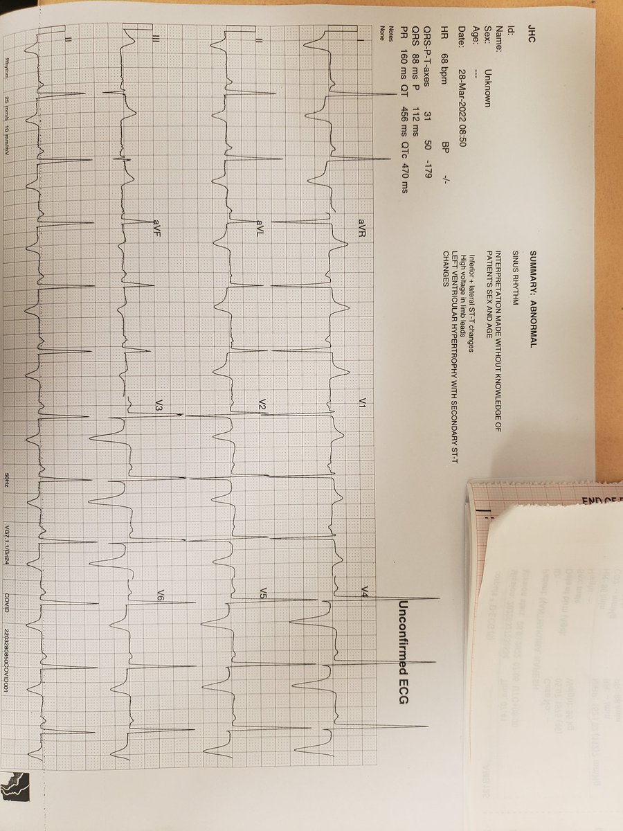 ElizabethAF's tweet photo. #MedTwitter I have a good one for you (shared with patient's permission).
46 year old Indian man with 2 weeks of palpitations called an ambulance for sudden SOB and mild interscapular ache. No chest pain. Brother had a sudden cardiac arrest 4 weeks ago. 1/2 https://t.co/Gg3xxPd8UM