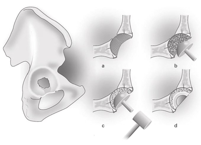 woolley_dr's tweet photo. Is impaction bone grafting in patients with acetabular and femoral defects a suitable option when treating young patients?

#hipsurgery #arthroplasty #ortho

https://t.co/zzU42BbeS4 https://t.co/P1zv6TDlNq