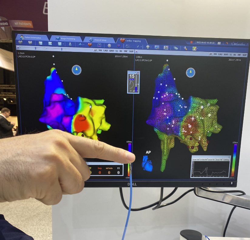 AleZe24104912's tweet photo. #EHRA2022 #MicroPortEP #MicroPortCRM #EPeeps #ContactForce https://t.co/JoVJVdDvY4