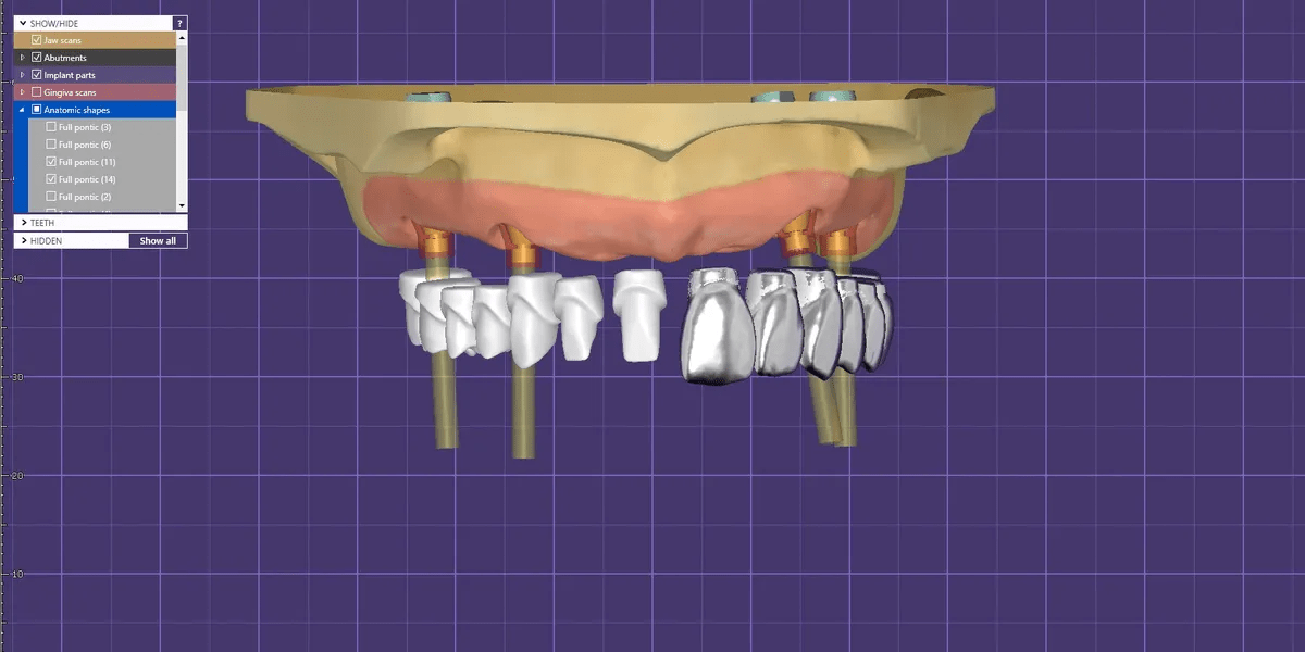 DigitalEdgeLab's tweet photo. providing a permanent fixed full arch restoration with teeth for delivery the next day after surgery. With EDGE24, our advanced process is revolutionary and a true next day delivery of your fixed full arch hybrid. 
https://t.co/gSEbsNRNFX https://t.co/M4m17zGSnM
