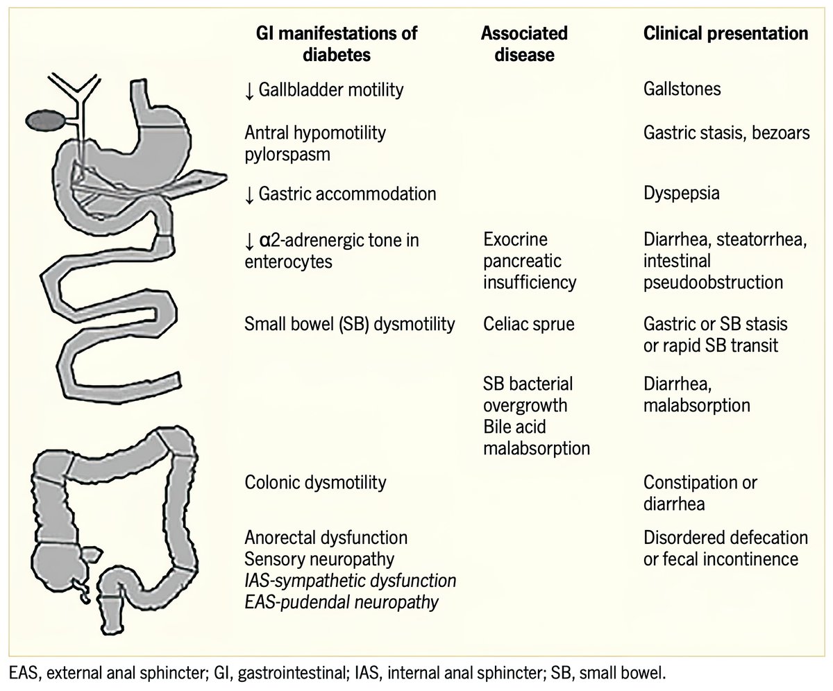 drkeithsiau's tweet photo. GI manifestations of diabetes #MedEd #GITwitter

https://t.co/dV43SvaCrw https://t.co/48nwlabzGP