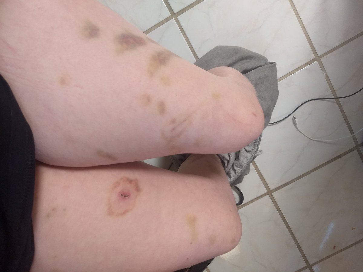 ethanpetrystan's tweet photo. Coming back to Twitter to say I need help. TW abuse. My bf beat me and his parents took everything of mine out the house. I have nowhere to go. I'm at a hotel but I'm completely out of money. If anyone could donate my cashapp is $stardusteuphoria. Please rt. https://t.co/LNHzGWkhVT