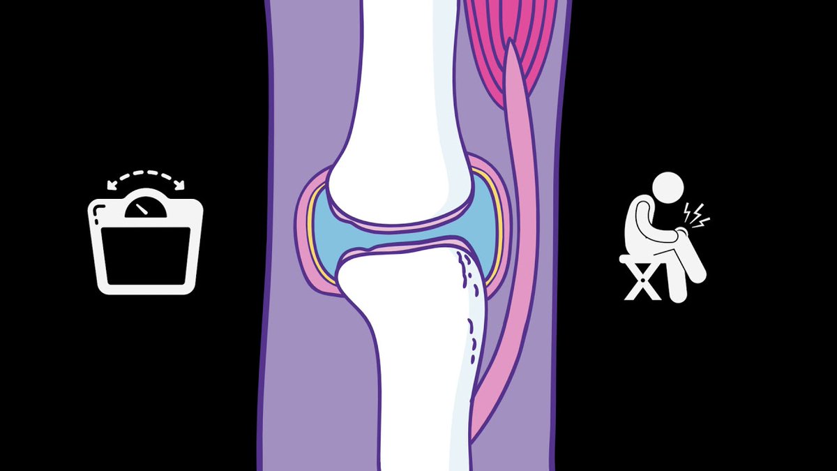 CBOrthopaedics's tweet photo. Have you heard of Osteoarthritis but not sure what it is? This video explains what causes it and what you can do to help with the pain. Take a look
https://t.co/Ng0Ee2roye
#osteoarthritis #whatisit #howtotreat #kneepain #symptoms https://t.co/jld0p5bMJw