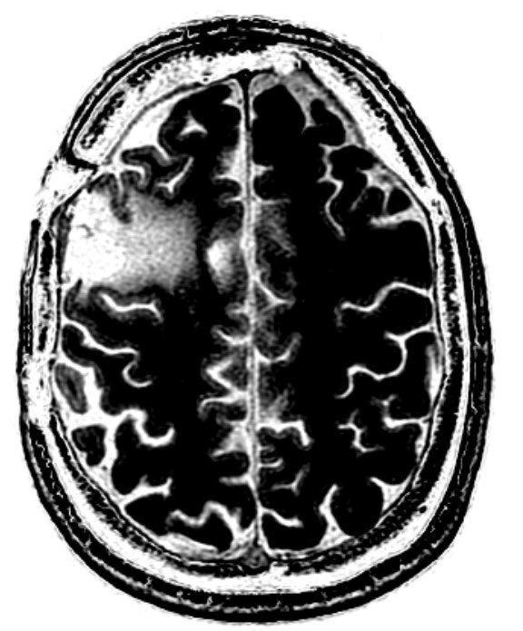 dipasqum's tweet photo. Post treatment excision site with highlighted radiation necrosis flare #aphasia #emotiondysregulation #executivefunction https://t.co/iovCfS08ex